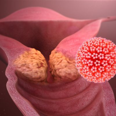 HPV ve Genital Siğiller